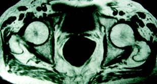 ) RM coronal T1 mostrando traço de hiposinal