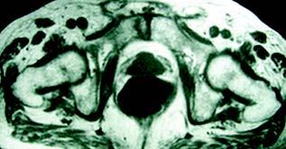 C) RM coronal STIR mostrando edema ósseo na