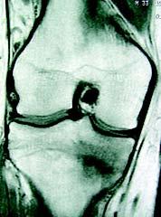 T1 e STIR (fratura), circundado por halo de edema medular ósseo.
