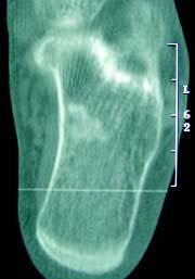 fratura na fíbula distal E.