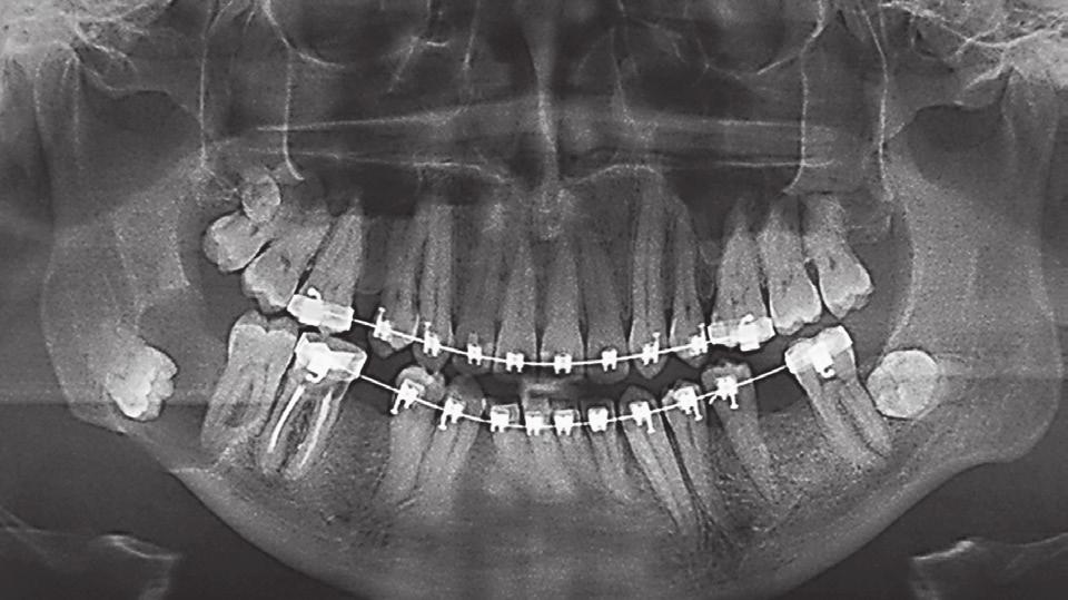 O paciente estava em tratamento ortodôntico, sendo encaminhado para o tratamento pertinente. Após a realização de biópsia, constatou-se cisto dentígero.