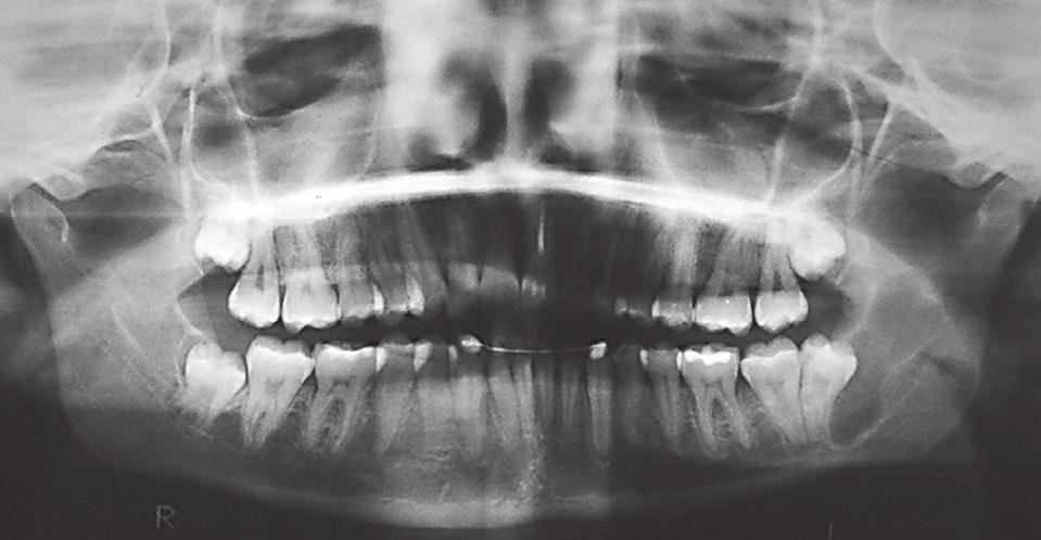 4), pôde-se observar, na radiografia panorâmica, um significativo aumento da imagem associada ao dente 38. O paciente foi encaminhado para o tratamento e, após exame histopatológico, constatou-se TOQ.