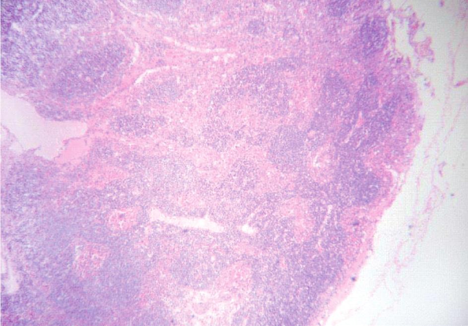 A análise do padrão de reatividade linfonodal no pescoço pn0 pode fornecer alguma informação prognóstica adicional em pacientes com carcinoma epidermoide de laringe? 71 Figura 4.