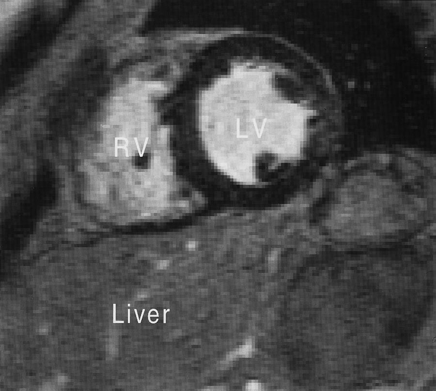 Figura 4. RMC na ponderação T2 evidenciando uma deposição maciça de ferro no miocárdio ventricular esquerdo, que se mostra muito hipointenso em relação ao fígado subjacente.