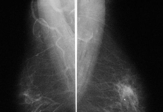 Assimetria focal de