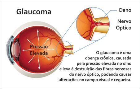 1.7 PRESSÃO INTRA OCULAR Os fluidos do globo ocular (humores aquoso e vítreo) estão sob pressão e mantêm o globo ocular numa forma e dimensão aproximadamente fixas.