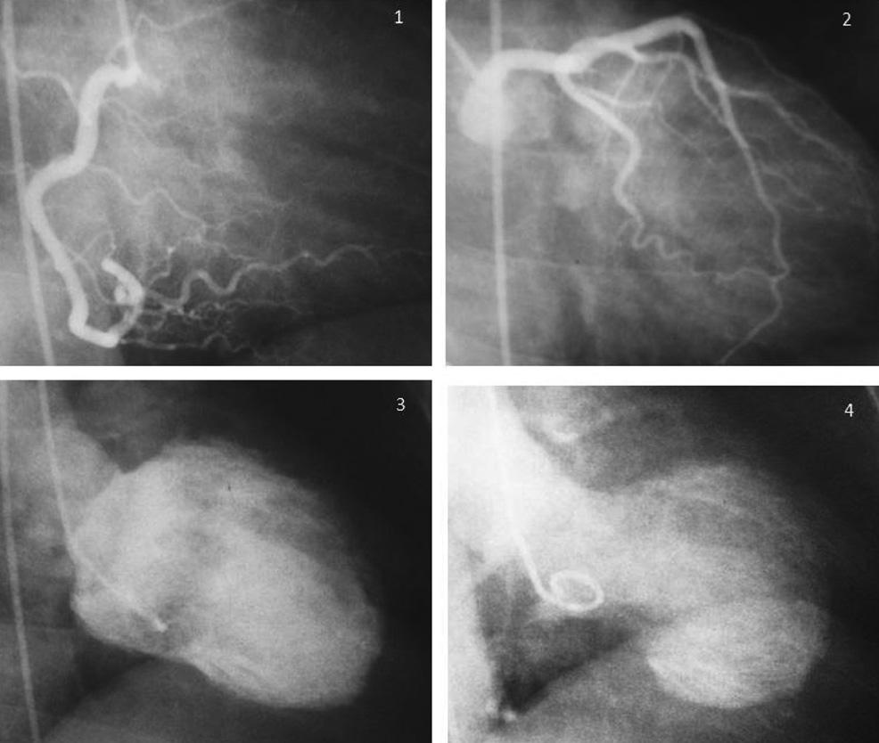 Figura 2 - Cineangiocoronariografia evidenciando: artéria coronária direita dominante (1), sistema coronário esquerdo (2), ventriculografia