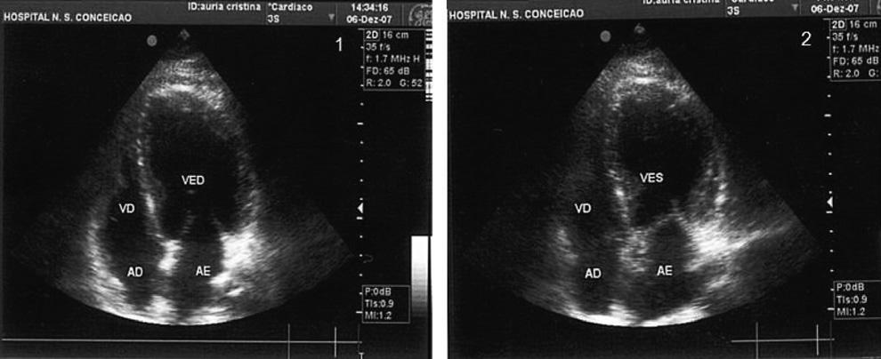 Figura 3 - Ecocardiografia transtorácica: diástole ventricular esquerda (1) e sístole ventricular esquerda com abaulamento apical do
