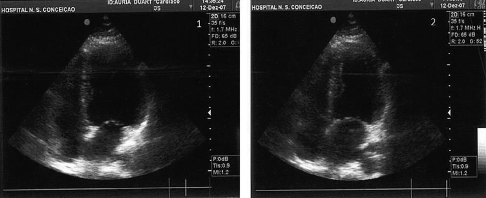 Figura 4 - Ecocardiografia transtorácica: diástole ventricular esquerda (1) e sístole ventricular esquerda com retorno da contratilidade normal (2).