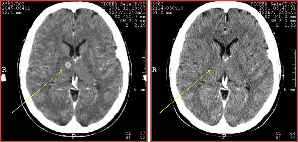 Radiocirurgia - Indicações frequentes: Critérios de Seleção : - metástases cerebrais - neurinomas - meningiomas - malformações artério-venosas (MAV).