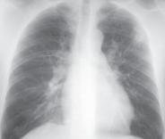 Topo do Algoritmo para a Detecção de Caso de TB Pulmonar Doente com sintomas Tosse 2-3 semanas Febre arrastada Suores nocturnos Perda de peso ------ RX Anormal Não Factores de Risco SIM VIH & outras