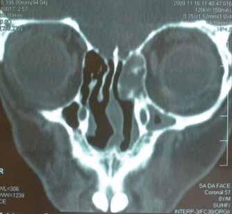 Figura 1. Tomografia dos seios paranasais. Figura 2. Nasoangiofibroma. dades craniofaciais devido à osteotomias realizadas durante esses procedimentos.