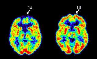 A Figura 1B mostra um cérebro normal na mesma área.