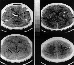 572 Arq Neuropsiquiatr 1998;56(3-B) Tabela 3. Alterações tomográficas apresentadas no primeiro exame dos 34 pacientes com edema cerebral crônico pela neurocisticercose.