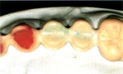 CONSIDERAÇÕES SOBRE A ESTRUTURA Funções e dimensões devem ser consideradas na elaboração do padrão de cera para pontes: I Padrão de cera do dente.