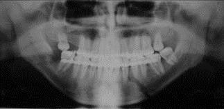 Figura 2. Sequência de radiografias panorâmicas após tratamento conservador da fratura de mandíbula.