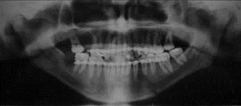 união sólida dos focos de fratura, com uma boa oclusão dentária.