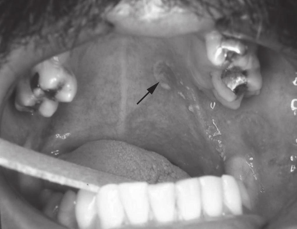 INTRODUÇÃO O termo eritroplasia oral é empregado para descrever lesão bucal macular ou em placa, de coloração vermelha, para a qual não pode ser estabelecido um diagnóstico clínico específico 1,2.