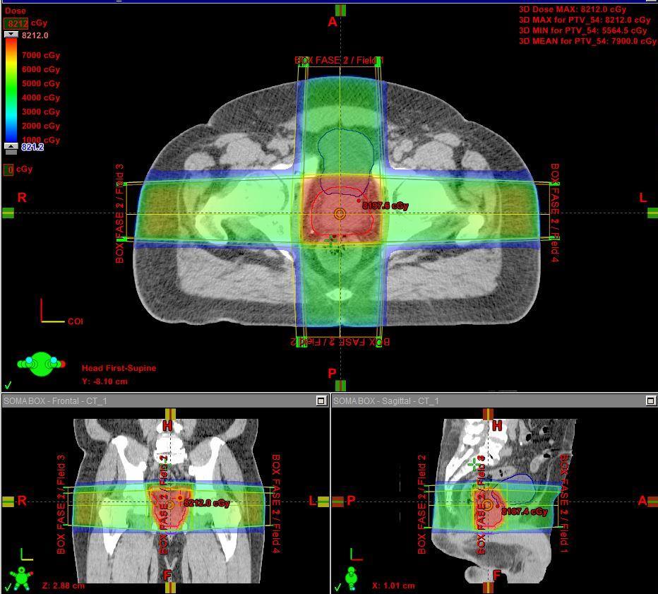 Radioterapia 3D: Tomografia de