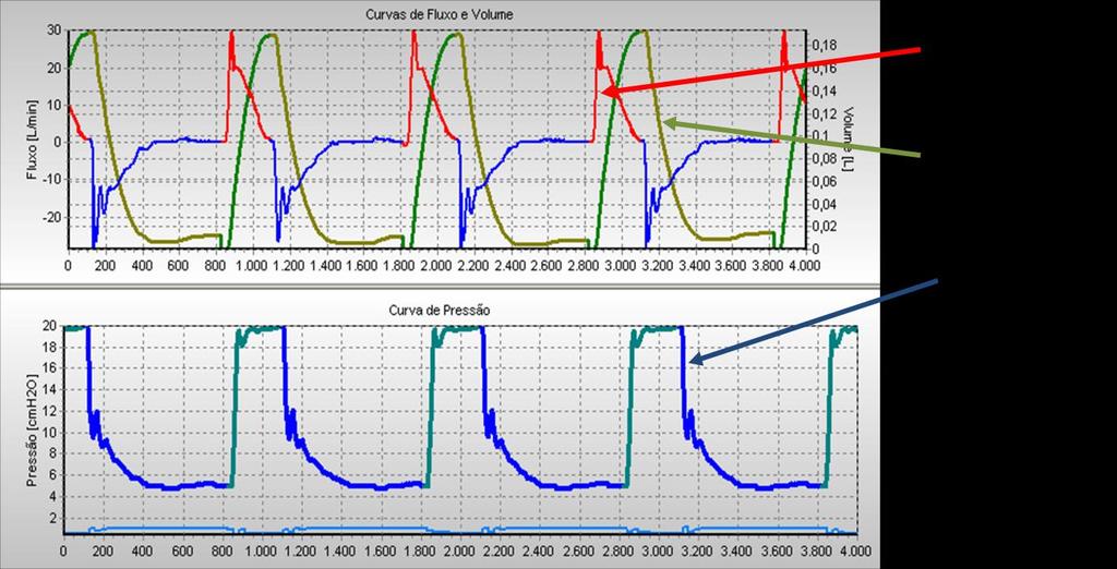 Capítulo 5 - RESULTADOS DE SIMULAÇÃO E IMPLEMENTAÇÃO Figura 269 Curva de PCV para paciente adulto com Rp50 e Complacência de 10mL/cmH 2 O.