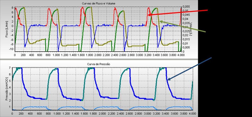 Projeto de Controladores para de Ventilação Mecânica Pulmonar L.2. Paciente infantil L.2.1.