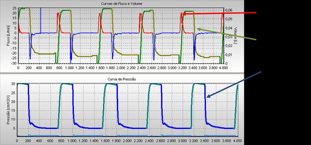 pressão máxima de 20 e PEEP de 5cmH 2 O.