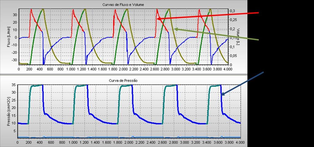 25 e PEEP de 10 cmh 2 O.