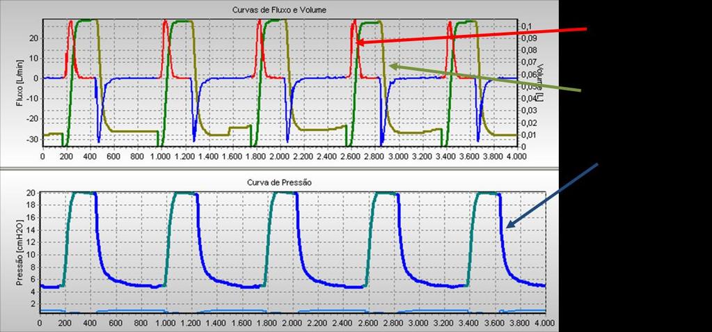 Projeto de Controladores para de Ventilação Mecânica Pulmonar L.2.