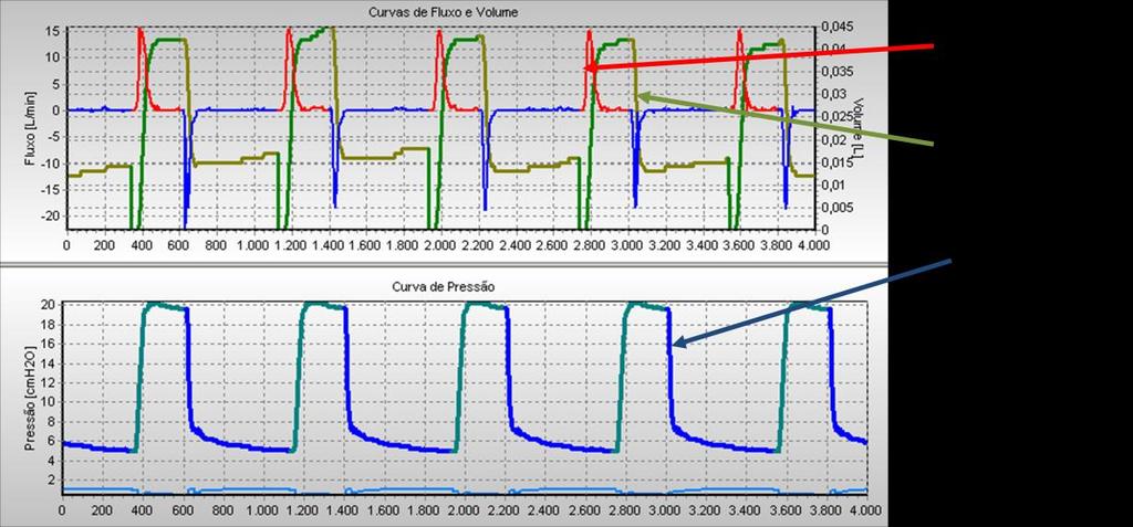 Projeto de Controladores para de Ventilação Mecânica Pulmonar Figura 404 PCV infantil usando simulador com resistência Rp10