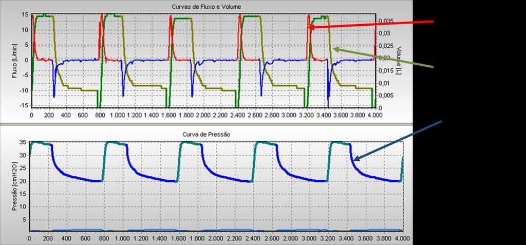 pressão máxima de 35 e PEEP de 10cmH 2 O.