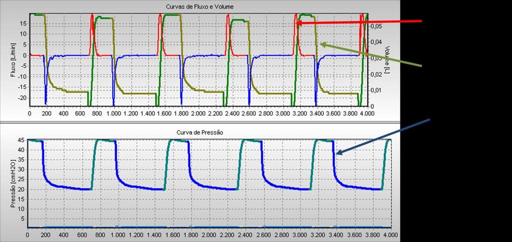 35 e PEEP de 20cmH 2 O.