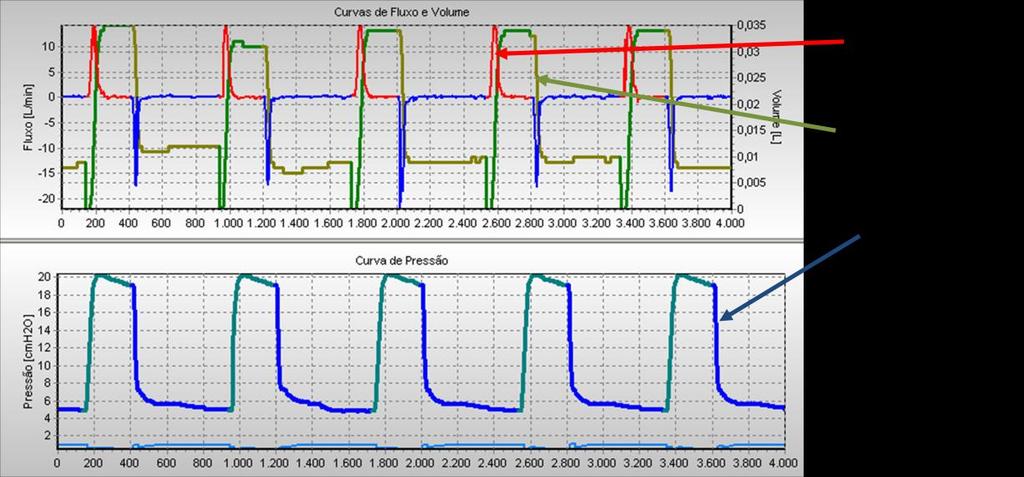 Projeto de Controladores para de Ventilação Mecânica Pulmonar L.3.1.