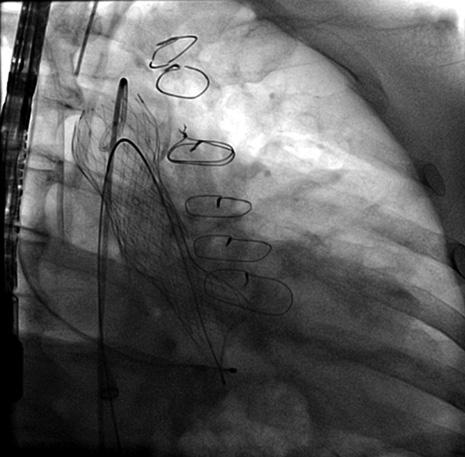 RBCI Vol. 19, Nº 4, 2011 371 Figura 2 - Duas próteses CoreValve TM em overlapping (valve-in-valve). CF I ou II de acordo com a classificação da New York Heart Association (NYHA).