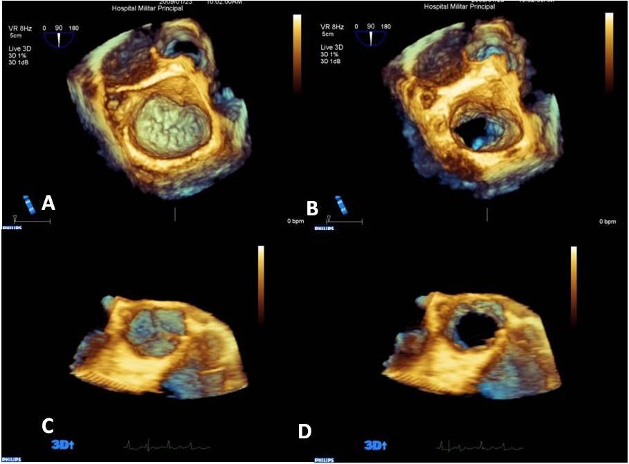 estenose mitral (n-9), doença mitral (n-2) seguido da avaliação de prótese valvular em posição mitral (n-8), dos aneurismas da aorta (n-5) e da cardiopatia valvular aórtica (n-3).