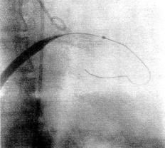 Bastos e cols Arq Bras Cardiol a dilatação do septo atrial e obtida confirmação da ausência de derrame pericárdico.