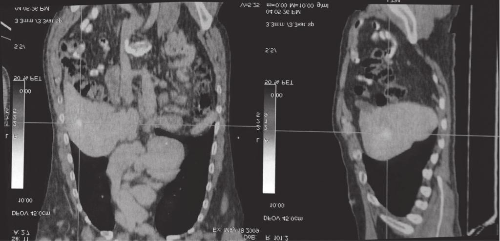 Moreno M; Miranda MHF INTRODUÇÃO O melanoma de coroide é o tumor intraocular mais comum em adultos 1.