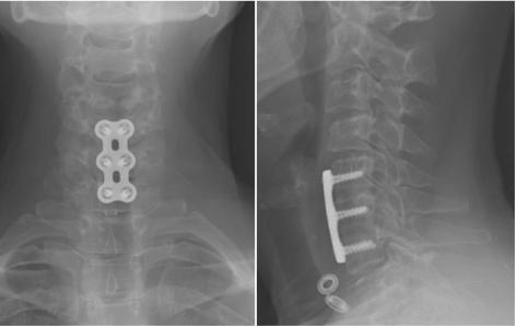 cervical evidenciando a presença de