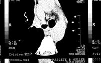 Exames radiologia broncoscopia Anastomose ampla (aço 3-) Radiologia Radiologia-CT