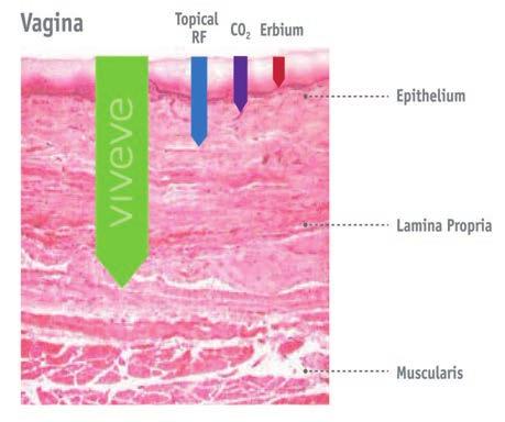 Aplicação da energia de RF não ablativa com penetração de até 5mm. 2. Ativação dos fibroblastos dentro da submucosa vaginal para iniciar a produção de novo colágeno. 3.