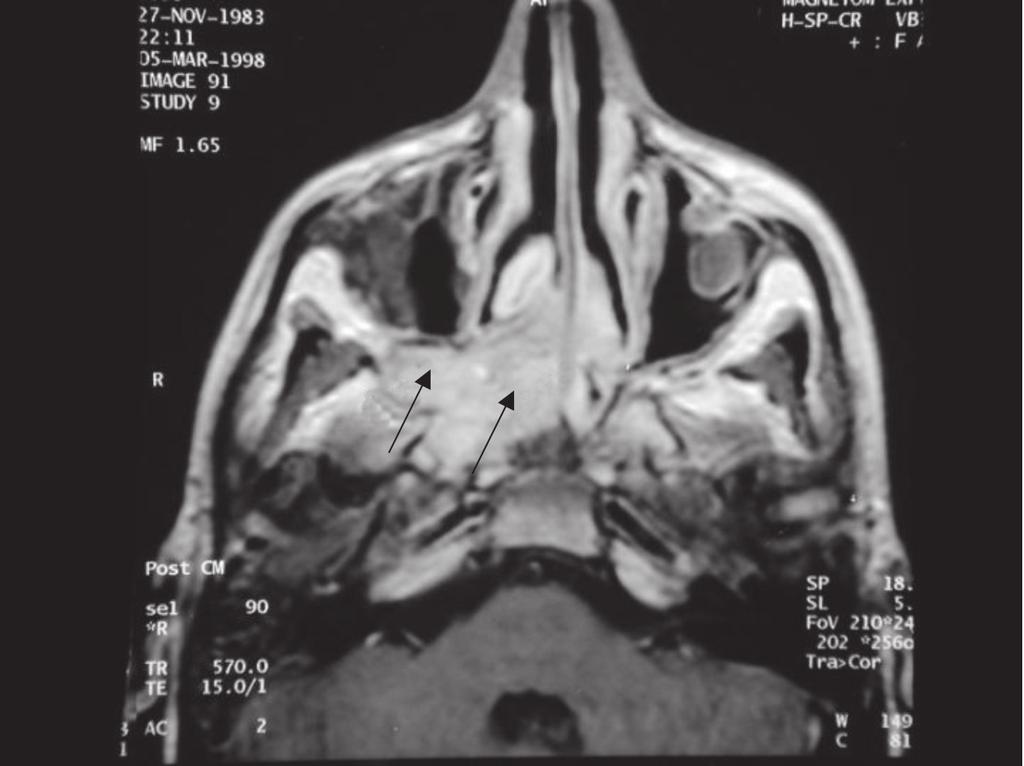 Figura 1 Figura 2 inferiormente, o tumor abaula o palato mole e pode ser visto na orofaringe.