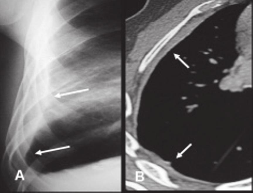 A ultra-sonografia (US) e a tomografia computadorizada (TC) podem ajudar na caracterização do derrame e na avaliação dos de menor volume 7, 8.