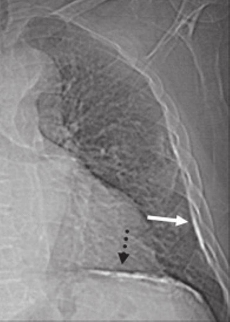 Fig. 3 Placas pleurais parietal (seta) e diafragmática (seta tracejada) na radiografia de tórax em póstero-anterior. Fig.