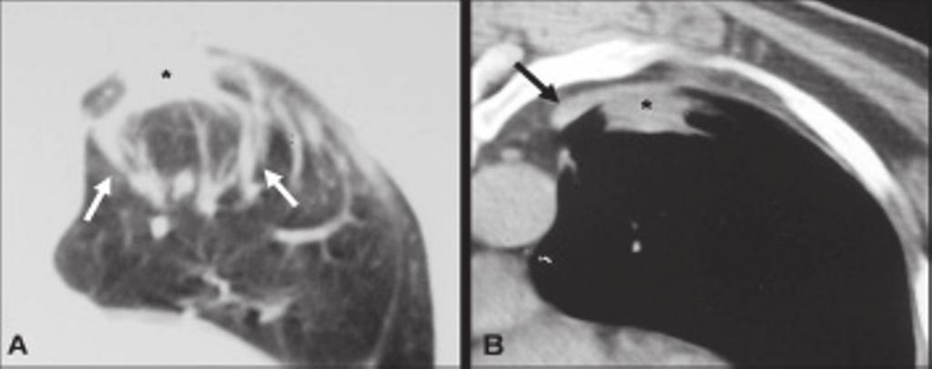 21 Na radiografia simples do tórax, a AR pode ser caracterizada como uma massa pulmonar periférica associada a espessamento pleural e distorção do parênquima pulmonar adjacente.