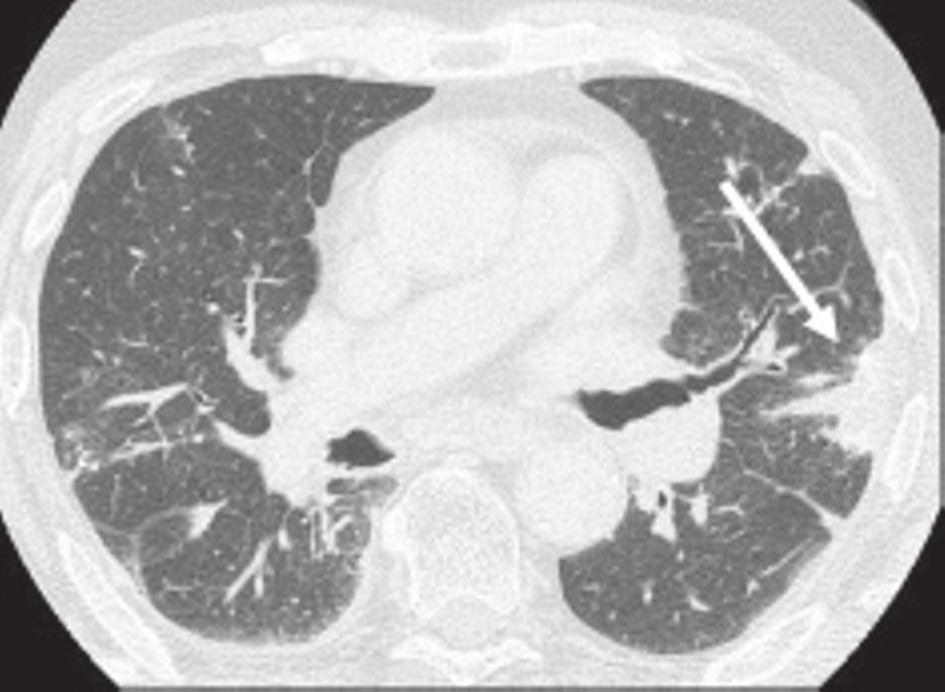 Carcinoma broncogénico A associação entre a exposição ao asbesto e o cancro do pulmão é considerada como de causa e efeito.