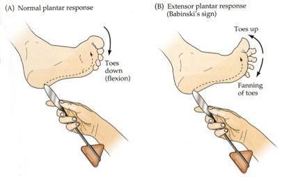 Espasticidade: aumento do tônus muscular (hipertonia) e aumento do reflexo miotático hiperativo (hiperreflexia miotática) 3.