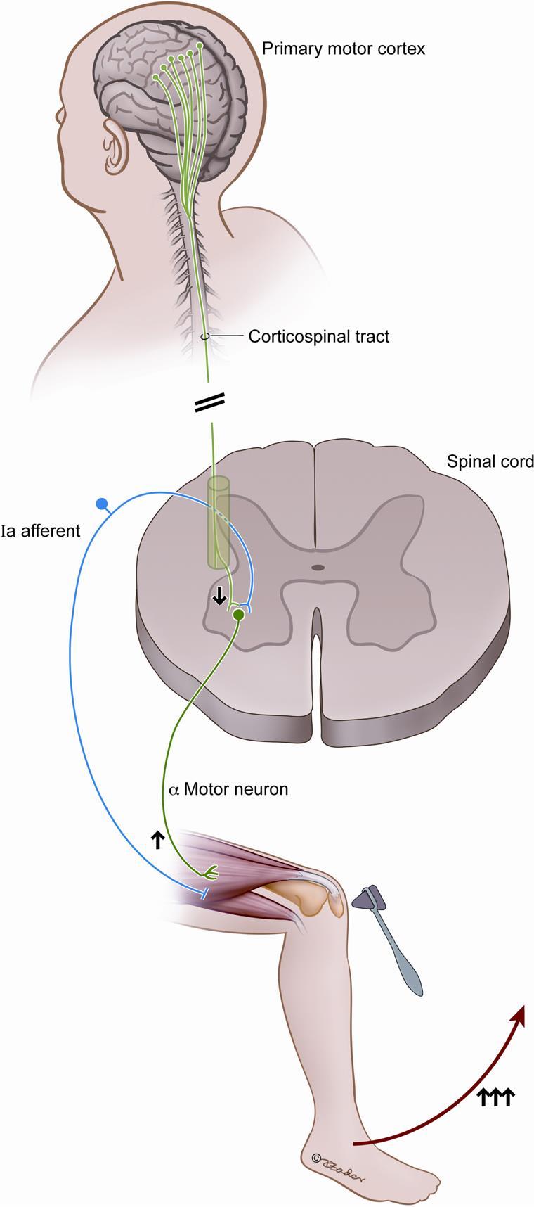 Achados Clássicos sugerem: Hipertonia e hiper-reflexia são respostas clássicas de lesões do neurônio superior.