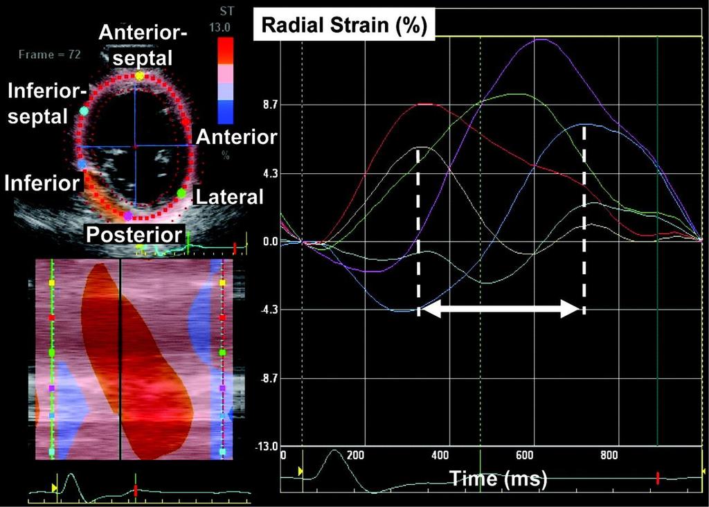Figura 3: Análise de curva Ɛ radial-tempo, em doente com IC com BRE. Ɛ radial calculado por ST ao longo de um ciclo cardíaco.
