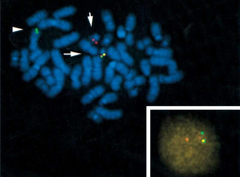 Gene ABL: cromossomo 9 Gene BCR: cromossomo 22
