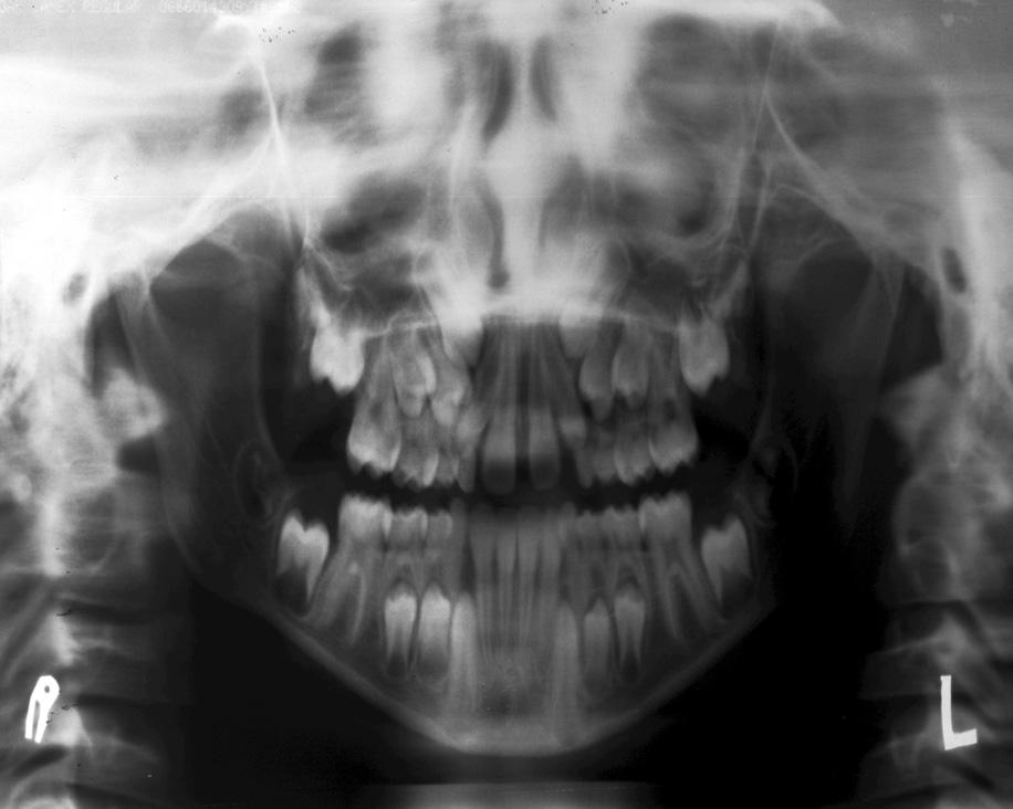 A importância da radiografia panorâmica no diagnóstico e no plano de tratamento ortodôntico Na época da dentadura mista é normal a presença de diastemas entre os incisivos superiores com divergência