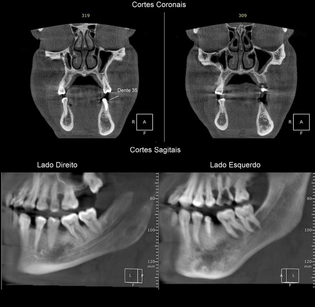 Caso IV Imagem de densidade mista, observada em corpo e base da mandíbula (com evidente expansão desta última), do lado